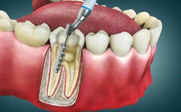 Root Canal