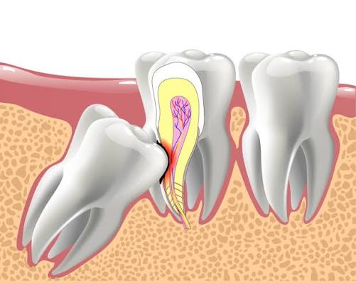 Impaction